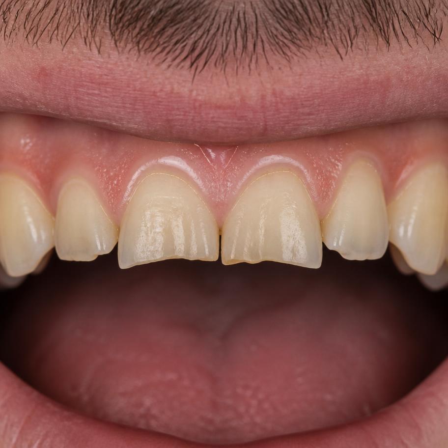 Carillas de porcelana en dientes anterosuperiores — antes