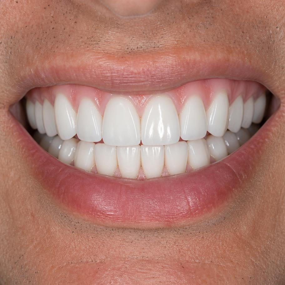Implante dental unitario en incisivo superior — después